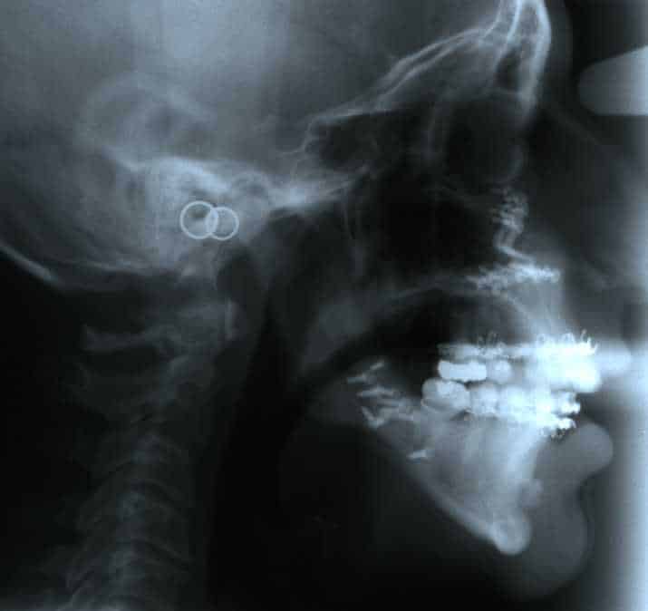 Before a jaw repositioning procedure in Ft. Lauderdale FL.