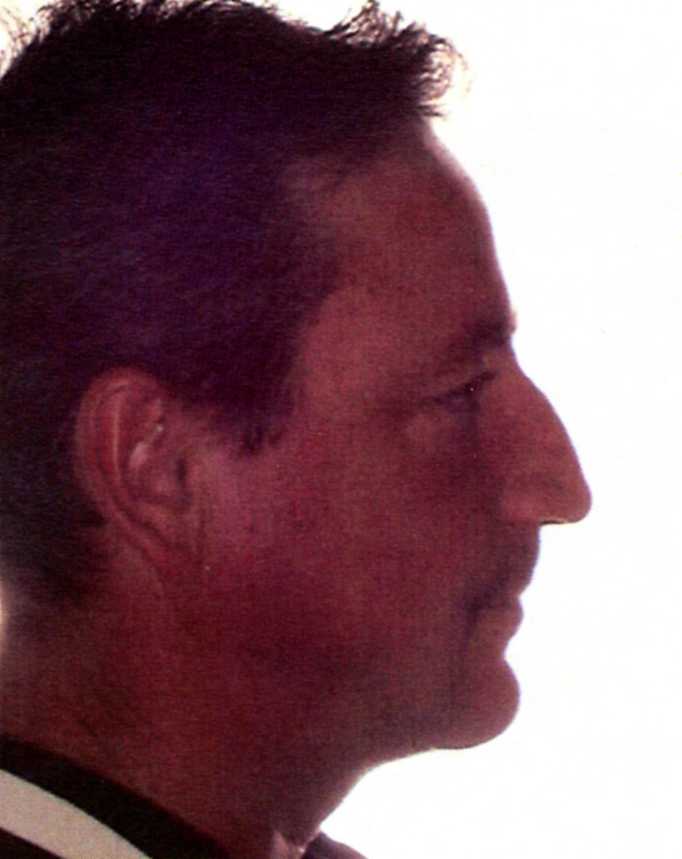 After a jaw repositioning procedure in Ft. Lauderdale FL.