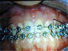 Titanium plates and screws to correct an open bite. Procedure offered by Oral Surgeon in Ft. Lauderdale FL