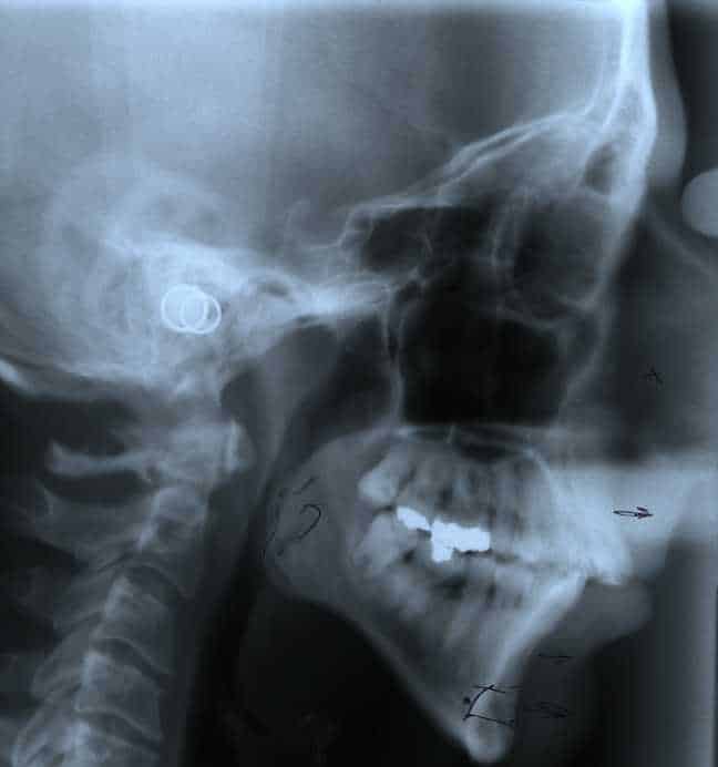 Before a jaw repositioning procedure in Ft. Lauderdale FL.
