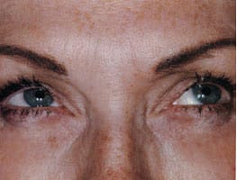 No Wrinkles After BOTOX treatment by Ft. Lauderdale FL Oral Surgeon
