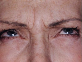 Wrinkles Before BOTOX treatment by Ft. Lauderdale FL Oral Surgeon