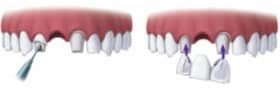 Bridge on Implant