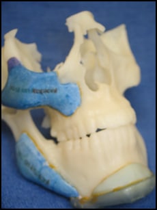 Lower jaw implant