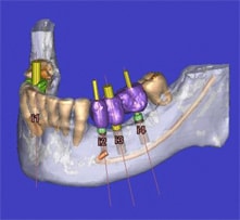 Computer guided virtual placement of 3 implants.