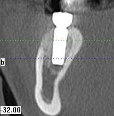 Postoperative result. Note sub-millimeter accuracy!