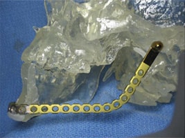 Pre-bent titanium plate to reconstruct jaw