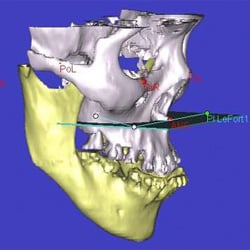 3D planning for maxillary advancement.