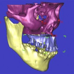 3D planning for maxillary advancement.