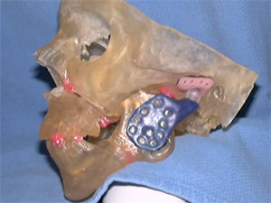 Patient with rheumatoid arthritis.