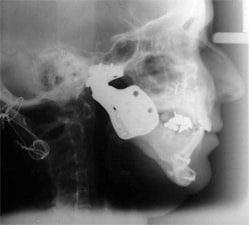 Postoperative result