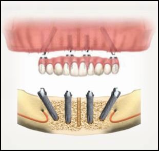 Dental Implants