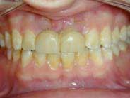 Dental Implant - fixed temporary bridge