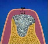 Dental Implant - fractured teeth