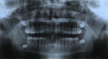 Radiograph of impacted wisdom teeth