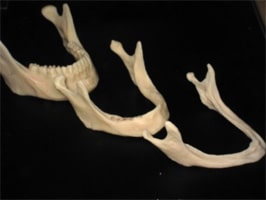 Bone loss due to age - treatable by Ft. Lauderdale FL Oral Surgeon