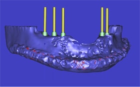 Bone loss due to age - treatable by Ft. Lauderdale FL Oral Surgeon