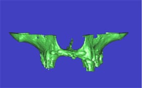 Bone loss due to age - treatable by Ft. Lauderdale FL Oral Surgeon