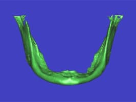 Bone loss due to age - treatable by Ft. Lauderdale FL Oral Surgeon