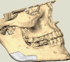 Removal of jaw tumor with custom cutting guide