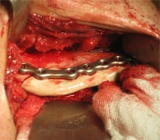 Removal of jaw tumor with custom cutting guide - Jaw Reconstruction