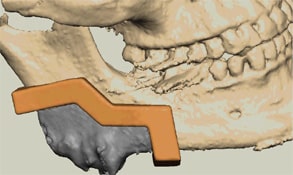 Removal of jaw tumor with custom cutting guide. Jaw reconstruction