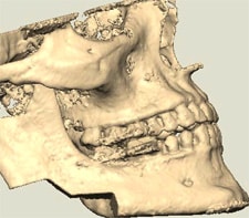 Removal of jaw tumor with custom cutting guide