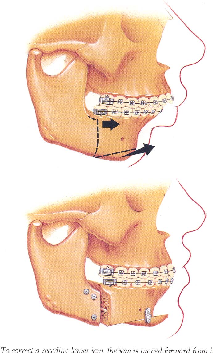 Jaw repositioning procedure in Ft. Lauderdale FL to treat sleep apnea.