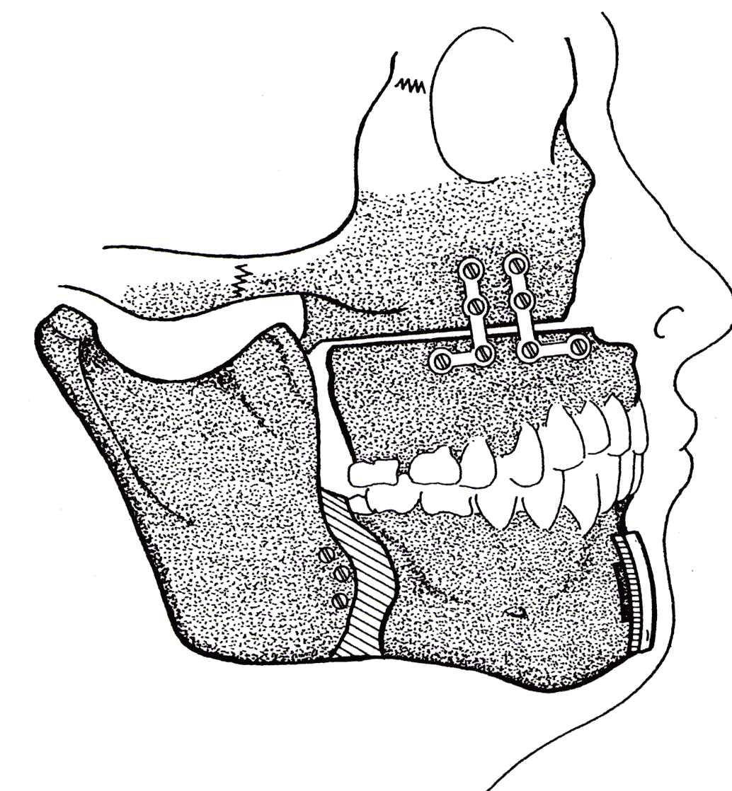 Jaw repositioning procedure in Ft. Lauderdale FL to treat sleep apnea.