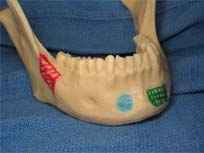 Oral Surgeon in Ft. Lauderdale FL may take a Bone graft from mandible - jaw bone.