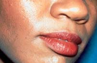 Before lesion removal by Ft. Lauderdale FL Oral Surgeon