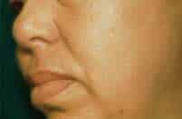 After lesion removal by Ft. Lauderdale FL Oral Surgeon