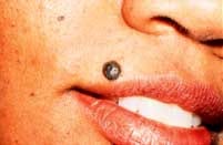 Before lesion removal by Ft. Lauderdale FL Oral Surgeon