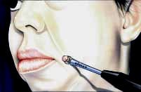 After lesion removal by Ft. Lauderdale FL Oral Surgeon