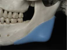 Cheek implant