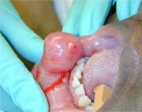 Oral Cancer detected by Oral Surgeon in Ft. Lauderdale FL