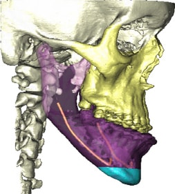 Orthognathic jaw surgery performed by Oral Surgeon in Ft. Lauderdale FL