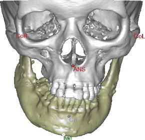 Orthognathic jaw surgery performed by Oral Surgeon in Ft. Lauderdale FL
