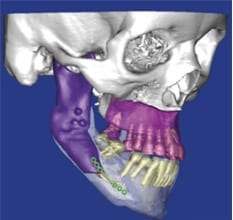 Orthognathic Surgery performed by Oral Surgeon in Ft. Lauderdale FL