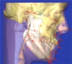 Orthognathic Surgery performed by Oral Surgeon in Ft. Lauderdale FL