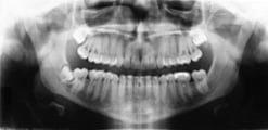 Panorex, a dental tomogram