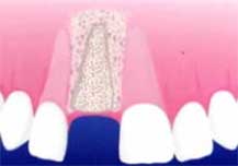 Dental Implant - fixed temporary bridge