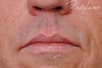 No Wrinkles After Restylane treatment by Ft. Lauderdale FL Oral Surgeon
