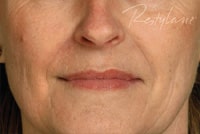 No Wrinkles After Restylane treatment by Ft. Lauderdale FL Oral Surgeon