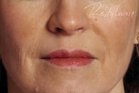 No Wrinkles After Restylane treatment by Ft. Lauderdale FL Oral Surgeon