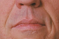 Wrinkles Before Restylane treatment by Ft. Lauderdale FL Oral Surgeon