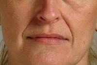 Wrinkles Before Restylane treatment by Ft. Lauderdale FL Oral Surgeon