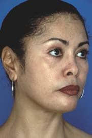 Even skin tones after treatment by Ft. Lauderdale FL Oral Surgeon