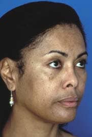 Uneven skin tones before treatment by Ft. Lauderdale FL Oral Surgeon