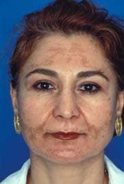 Uneven skin tones before treatment by Ft. Lauderdale FL Oral Surgeon